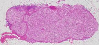 Metastatic lymph node completely replaced by cancer