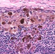 Nest of cancer cells at edge of lymph node